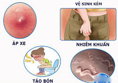 Có nhiều nguyên nhân dẫn tới rò rỉ hậu môn hiệu quả