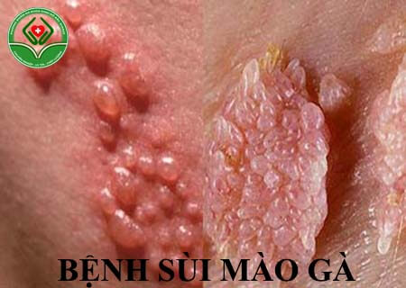 bệnh sùi mào gà là gì