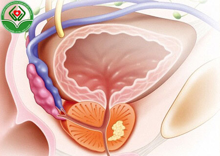 Bệnh viêm tuyến tiền liệt là bệnh gì
