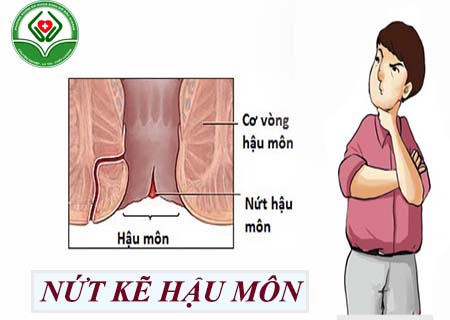 Nứt kẽ hậu môn là gì