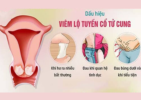 Viêm lộ tuyến cổ tử cung có 5 dấu hiệu