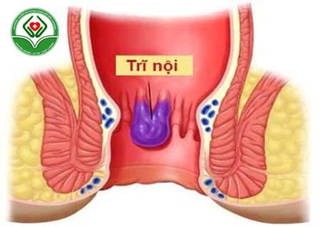 http://phongkhamkinhdo.vn/nguyen-nhan-gay-tri-ngoai/ Chữa bệnh trĩ nôi