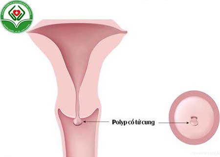 polyp cổ tử cung là gì