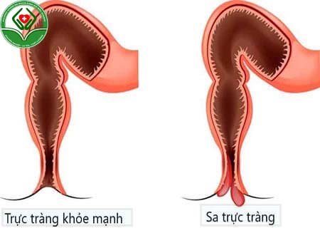 Sa trực tràng là gì ?