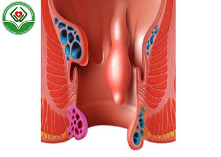 Triệu chứng bệnh trĩ hỗn hợp