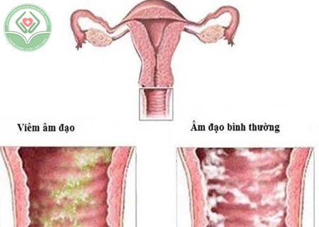 Viêm âm đạo - bệnh lý không được chủ quan