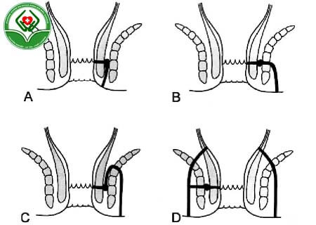 Cách chữa bệnh hậu môn