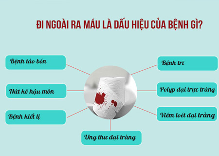 Điều trị đi ngoài ra máu được điều trị bằng kỹ thuật hiện đại