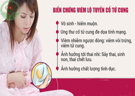 Viêm lộ tuyến cổ tử cung cần chữa trị đúng phương pháp