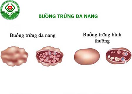 buồng trứng đa nang là gì