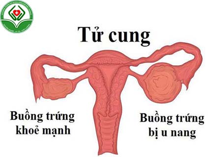 cách chữa u nang buồng trứng