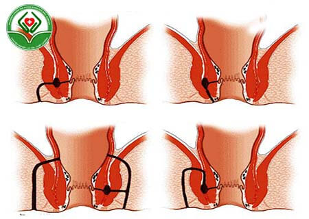 Hình ảnh rò rỉ hậu môn