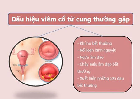 Các dấu hiệu của bệnh viêm cổ tử cung