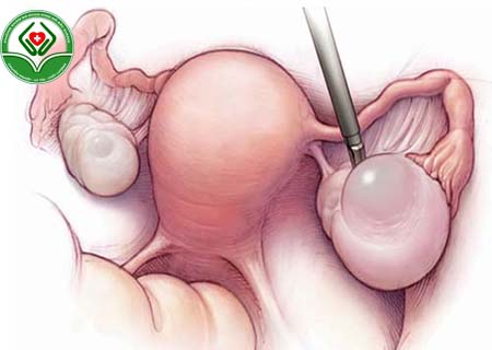 điều trị u nang buồng trứng tại Bắc Giang