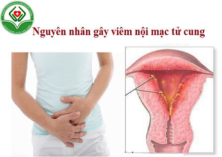 Nguyên nhân gây viêm nội mạc tử cung ở nữ giới