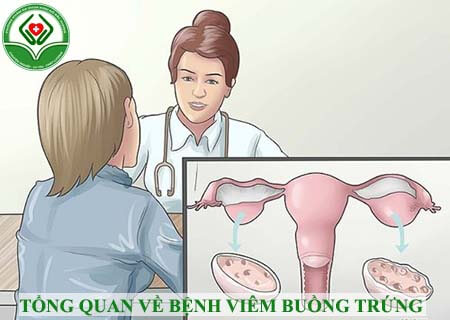 tổng quan về bệnh viêm buồng trứng