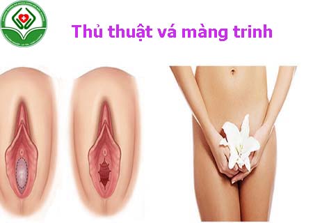 Vá màng trinh như thế nào