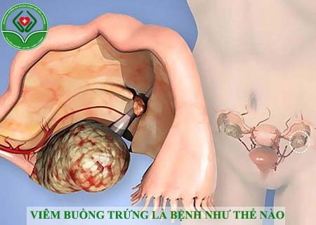 viêm buồng trứng là bệnh như thế nào