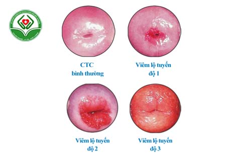 Viêm lộ tuyến cổ tử cung