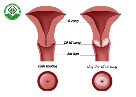 Viêm lộ tuyến gây ung thư cổ tử cung