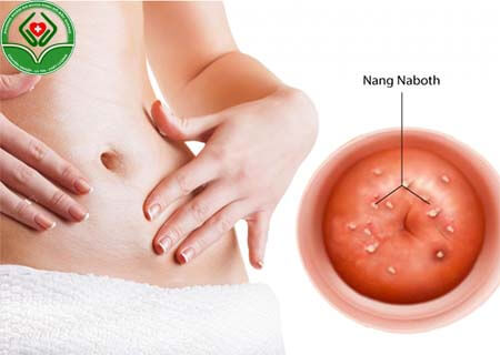 Bệnh naboth tử cung là gì