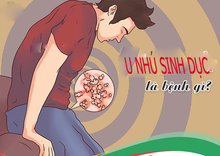 U nhu sinh dục là căn bệnh nguy hiểm 