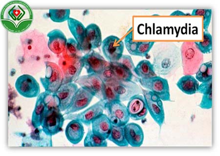bệnh chlamydia là bệnh gì