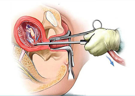 Phương pháp phá thai bằng ống siêu dẫn hiệu quả an toàn