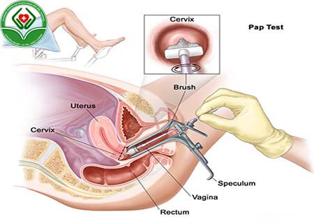 Quy trình xoắn polyp cổ tử cung