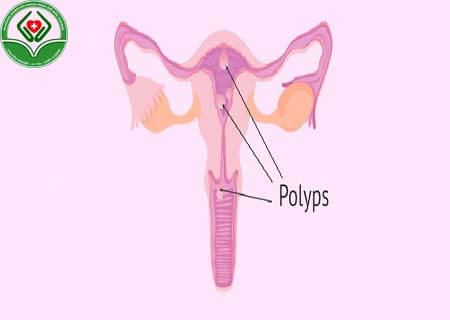 Xoắn polyp cổ tử cung là gì