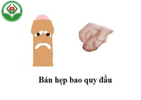 Bán hẹp bao quy đầu