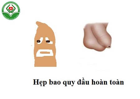 Hẹp bao quy đầu hoàn toàn