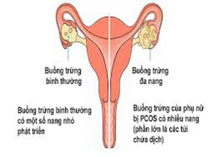 Viêm buồng trứng là một trong những bệnh dẫn đến vô sinh nữ