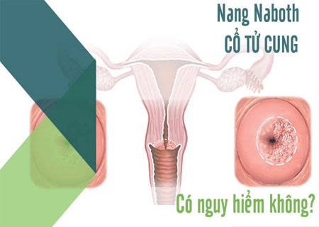 Nang Naboth cổ tử cung bị vỡ gây nguy hiểm lớn