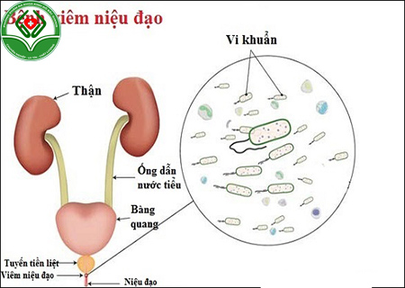 tại sao đi tiểu khó