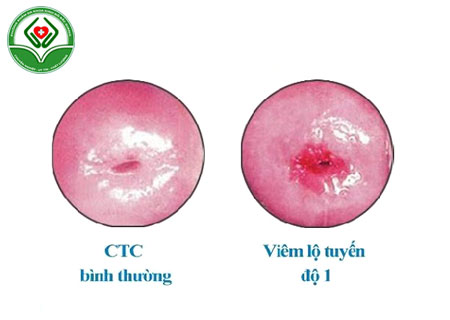 hinh-anh-benh-viem-lo-tuyen-co-tu-cung