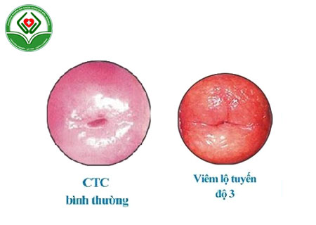 hinh-anh-benh-viem-lo-tuyen-co-tu-cung