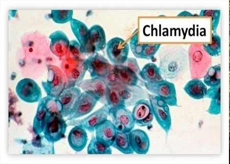 Bệnh Chlamydia là căn bệnh lây nhiễm nguy hiểm