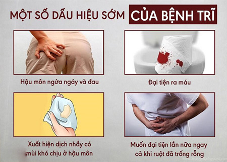 Bệnh trĩ giai đoạn đầu có thể nhận biết qua một số triệu chứng cụ thể