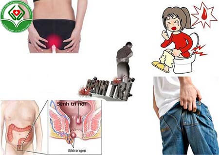 Ưu điểm của HCPT