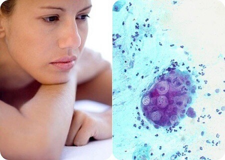 Chữa bệnh chlamydia ở đâu tốt nhất Chữa bệnh chlamydia ở đâu tốt nhất