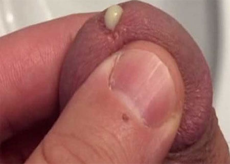 biểu hiện của bệnh lậu biểu hiện của bệnh lậu