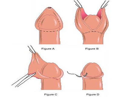 Cắt bao quy đầu có lợi gì