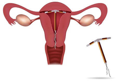 Đặt vòng tránh thai là phương pháp tránh thai phổ biến