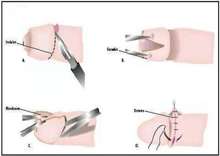 Thời gian tháo băng phụ thuộc vào cơ địa từng người