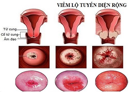 Viêm lộ tuyến 2cm gây nguy hại cho phụ nữ