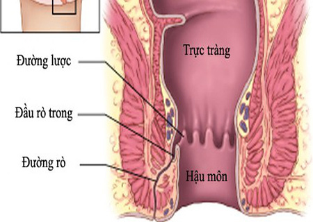Người bị bệnh táo bón dễ mắc bệnh trực tràng hậu môn