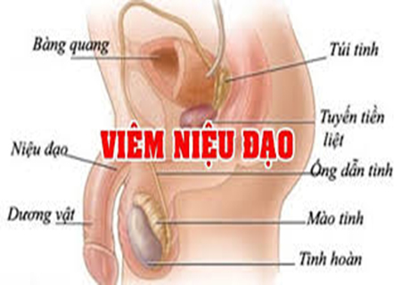 Chữa viêm niệu đạo bằng phương pháp ZD-2018