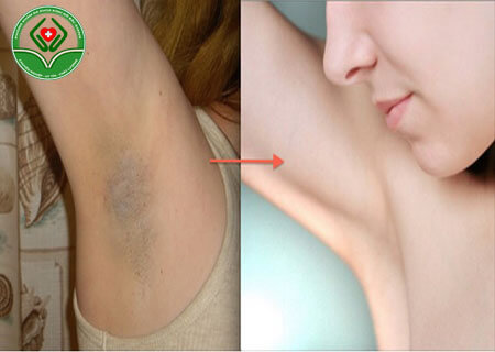 Nội soi hút tuyến mồ hôi nách