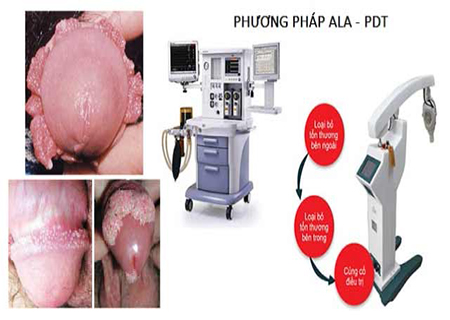 Phương pháp ALA-PDT chữa sùi mào gà